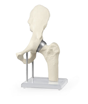 Hip joint model with shell prosthesis